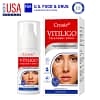 Croaie® Vitiligo Treatment Spray – No allergies