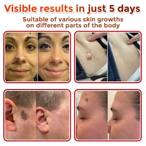 LOVILDS® MicroNeedle Botanic Skin Tag Removal Patch