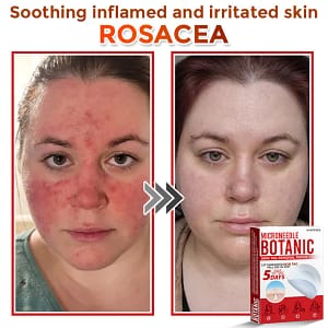 LOVILDS® MicroNeedle Botanic Skin Tag Removal Patch