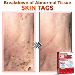 LOVILDS® MicroNeedle Botanic Skin Tag Removal Patch