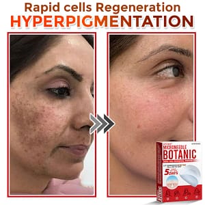 GFOUK® MicroNeedle Botanic Skin Tag Removal Patch