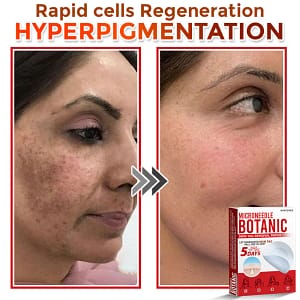 LOVILDS® MicroNeedle Botanic Skin Tag Removal Patch