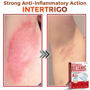 GFOUK® MicroNeedle Botanic Skin Tag Removal Patch