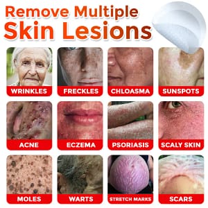 LOVILDS® MicroNeedle Botanic Skin Tag Removal Patch