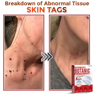 LOVILDS® MicroNeedle Botanic Skin Tag Removal Patch