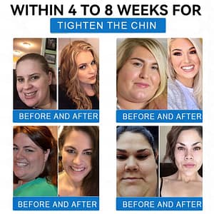 LERCEA® SMGT-GLP-1 Tirzepatide & Collagen Nano Microneedle Weight Loss Patch