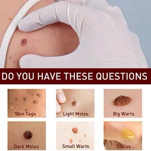 Fivfivgo™ WipeOff Tags & Mole Remover