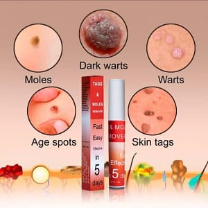 Fivfivgo™ WipeOff Tags & Mole Remover