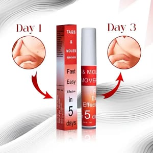 Fivfivgo™ WipeOff Tags & Mole Remover