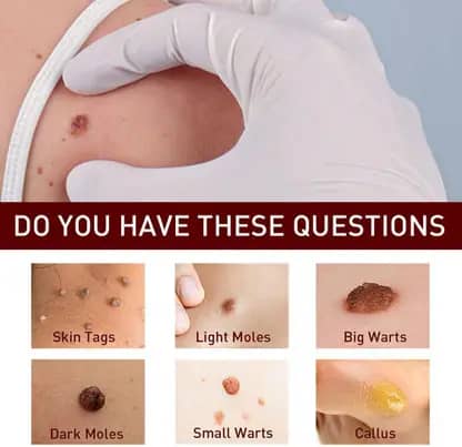 Fivfivgo™ WipeOff Tags & Mole Remover