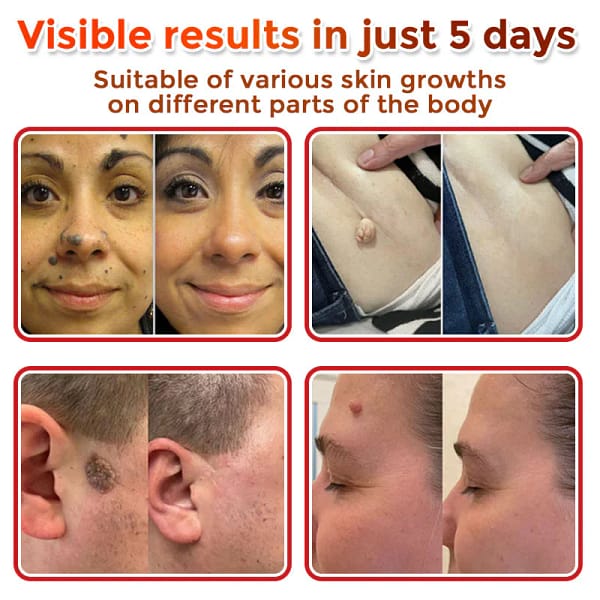LOVILDS® MicroNeedle Botanic Skin Tag Removal Patch