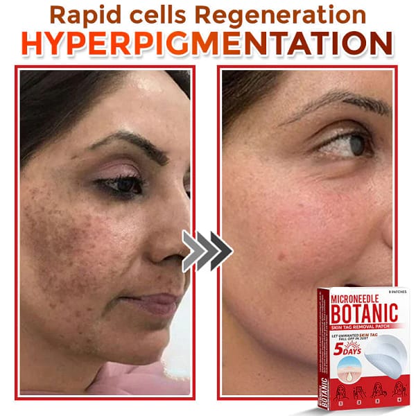 LOVILDS® MicroNeedle Botanic Skin Tag Removal Patch