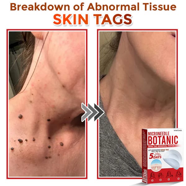 LOVILDS® MicroNeedle Botanic Skin Tag Removal Patch