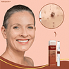 DermaLift™ Pen | Removes warts and age spots