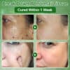 Zvoevo® Tea Tree Oil Skin Treatment Cream