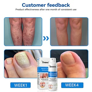 Zvoevo®Magnesium Herbal Psoriasis Spray
