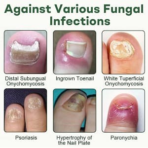Dobshow® Nail Fungus Renewal Gel