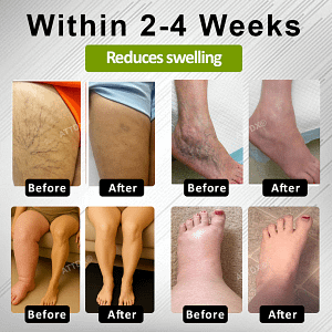 ATTDX® Fluid Regulation Edema Care Cream