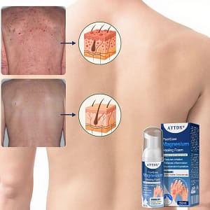 ATTDX® PsoriEase Magnesium Healing Foam