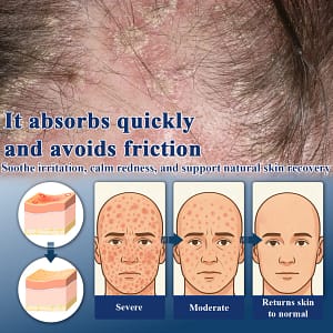 ATTDX® PsoriEase Magnesium Healing Foam