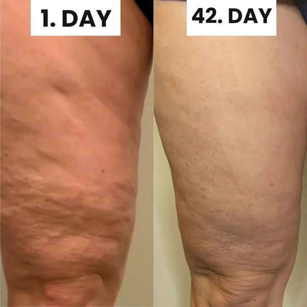 SheVitality™ Cellulite Relief Kit - Image 6