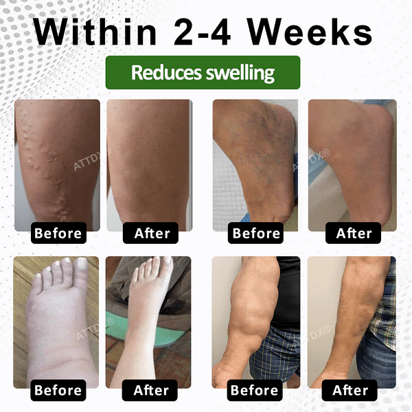 ATTDX® SwellSoothe Lymphatic Cream