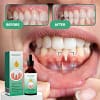 GumVital™ | Restores receding gums in 93% of the cases within 4 days