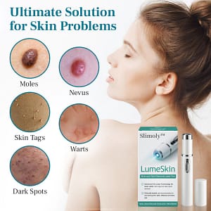 Slimoly™ LumeSkin Mole and Wart Removal Laser Pen 