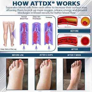 ATTDX® EdemaEase Black Cumin Therapy Cream