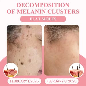 LUHAKA® Dual Acid Wart & Mole Removal Serum