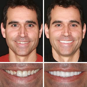 Laozik™ Advanced Customized Full Denture Set