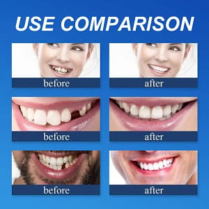 Laozik™ Advanced Customized Full Denture Set
