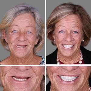 Laozik™ Advanced Customized Full Denture Set