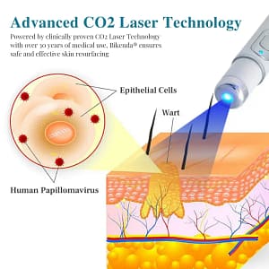 Bikenda® LumeSkin Mole and Wart Removal Laser Pen