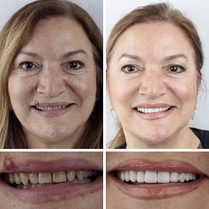 Laozik™ Advanced Customized Full Denture Set