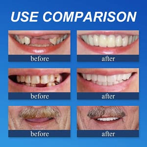 Laozik™ Advanced Customized Full Denture Set