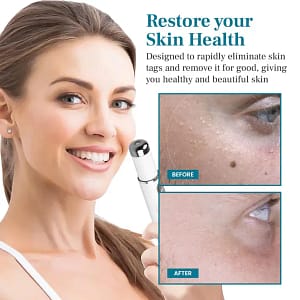 Bikenda® LumeSkin Mole and Wart Removal Laser Pen