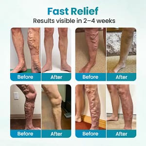 Timilk® VeinAway Relief Cream