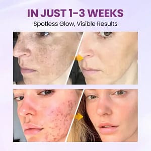 Clinclii™ Radiant Clear Blemish & Brightening Serum