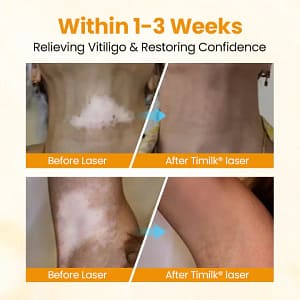 Timilk® VitiGone Rapid Spray — 2–3 Week Repigmentation with OTDS