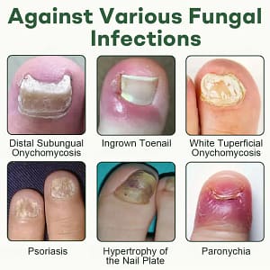 Dobshow® Nail Fungus Renewal Gel