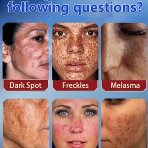 Bikenda™️ Blemish Removing Beauty Cream