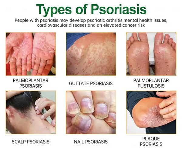 Cvreoz® Knotaway Psoriasis Cream