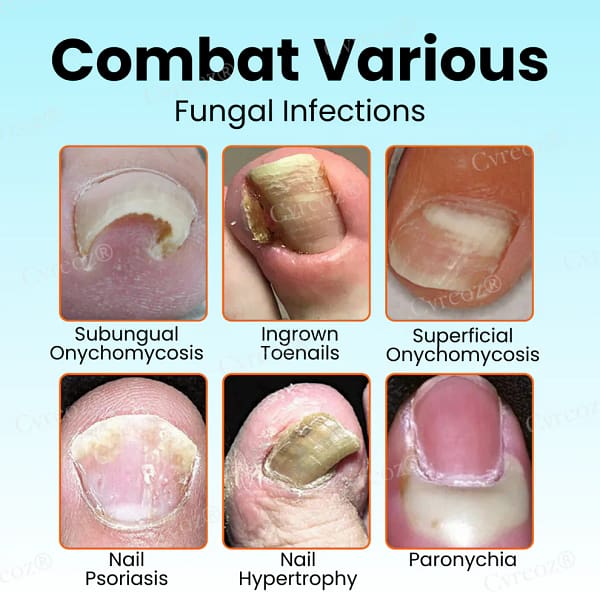 Cvreoz® Nail Strengthening Ointment