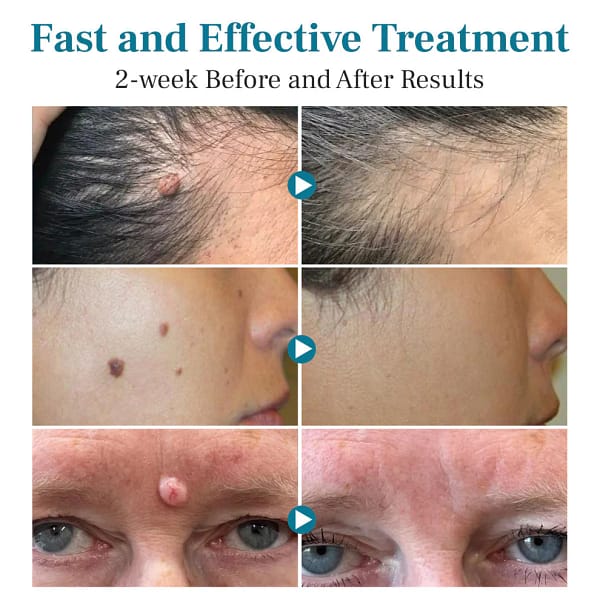 Slimoly™ LumeSkin Mole and Wart Removal Laser Pen 
