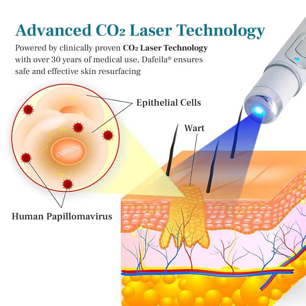 Slimoly™ LumeSkin Mole and Wart Removal Laser Pen 