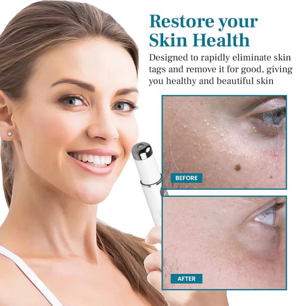 Slimoly™ LumeSkin Mole and Wart Removal Laser Pen 