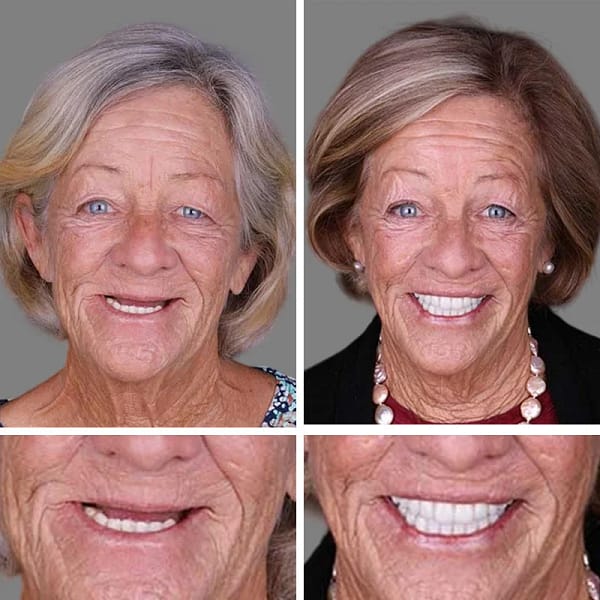 Laozik™ Advanced Customized Full Denture Set