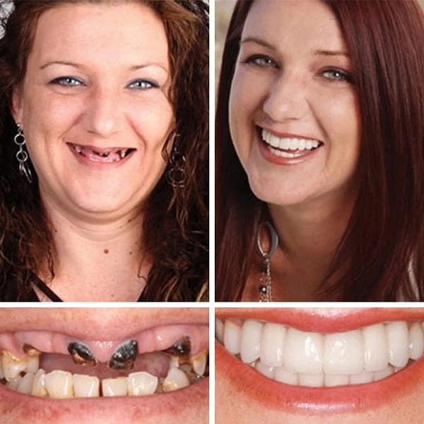 Laozik™ Advanced Customized Full Denture Set