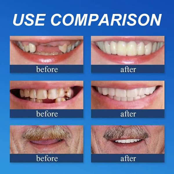 Laozik™ Advanced Customized Full Denture Set